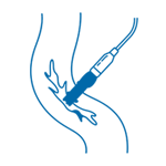 Percutaneous left atrial appendage closure